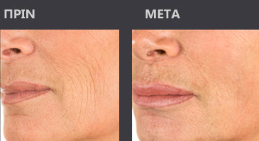 Μεσοθεραπεί! Μέθοδος αναζωογόνησης χωρίς νυστέρι!