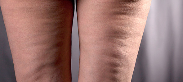 Δείτε την ΑΠΟΛΥΤΗ σπιτική συνταγή κατά της κυτταρίτιδας! Υπόσχεται να βελτιώσει την εικόνα των μηρών και των γλουτών σας σε ΕΝΑΝ ΜΗΝΑ!